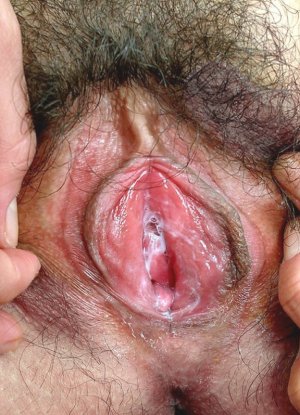 Инфантильная вульва картинка 3